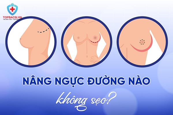 Nâng ngực đường nào không sẹo?