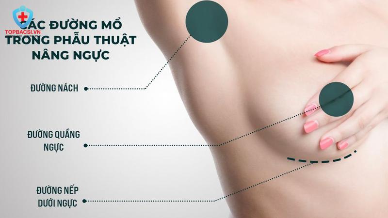 Các đường nâng ngực phổ biến nhất