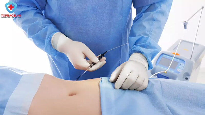 Lý tưởng mỗi lần chỉ nên hút mỡ tương đương 2-3% trọng lượng cơ thể.