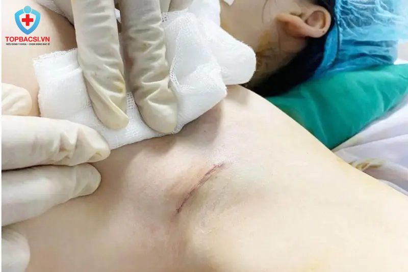 Giải Mã Nâng Ngực Nội Soi Đường Nách: Có An Toàn Không, Ai Nên Thực Hiện?