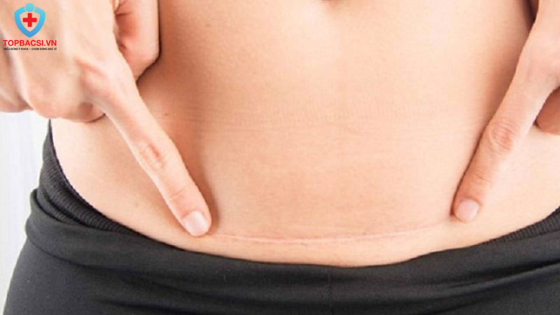 Hình ảnh sẹo sau hút mỡ bụng thực tế.