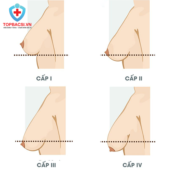 Các cấp độ ngực chảy xệ sau sinh.