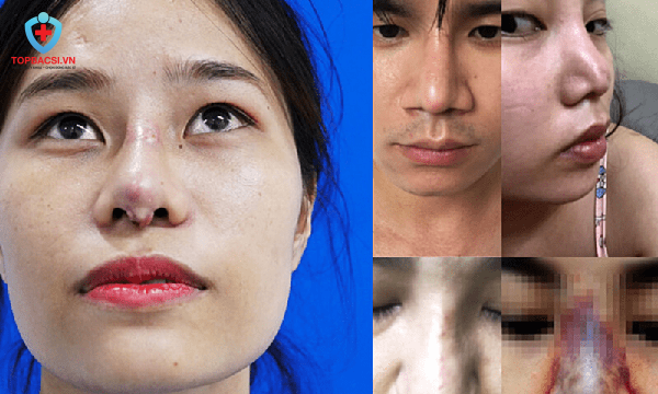 Biến chứng sau khi nâng mũi bị lộ sóng.