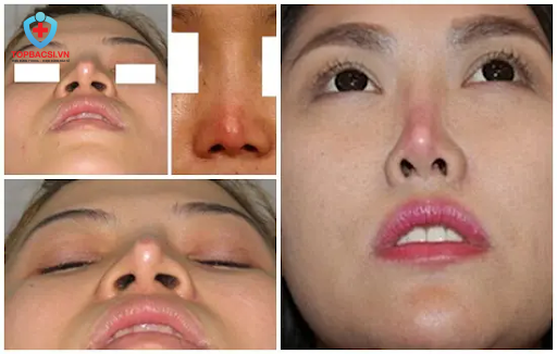 Mũi lộ sóng là gì?