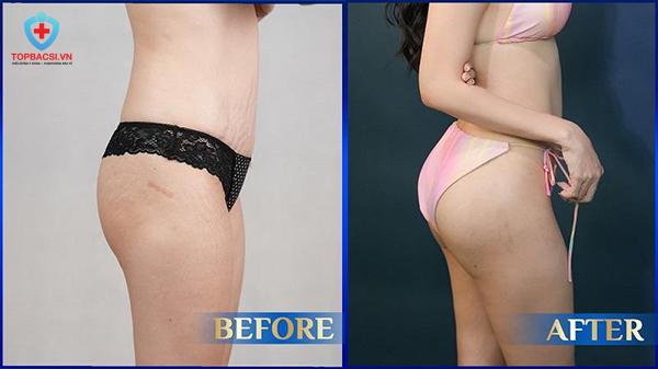 Hình ảnh Before/After nâng mông.