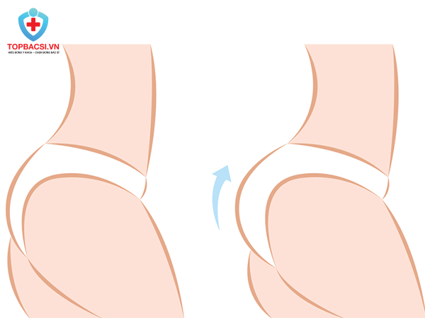 Mô phỏng hình ảnh trước/sau thực hiện nâng mông.