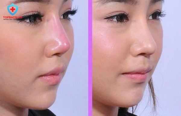 Nâng mũi bị bóng đỏ đầu mũi là như thế nào?