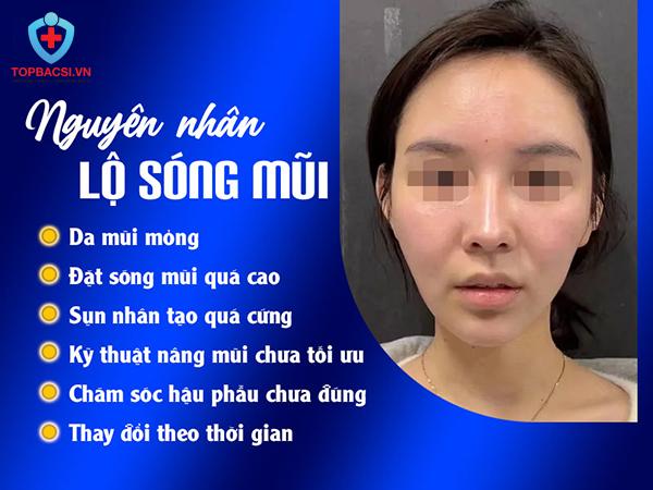 Các nguyên nhân lộ sóng mũi.