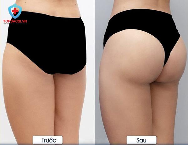 Phẫu thuật thẩm mỹ nâng mông là gì?