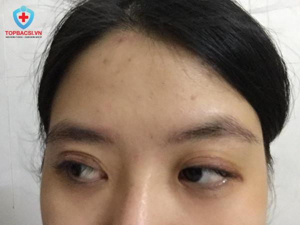 Phẫu thuật cắt mắt đã đến lần thứ hai tại TMV Bs.Ngô Mộng Hùng nhưng vẫn không được như cam kết.
