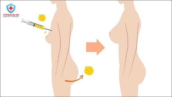 Quá trình bóc tách và cấy mỡ tự thân vào cơ thể.