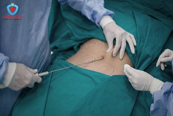 Bác sĩ thực hiện hút mỡ bụng cho bệnh nhân.