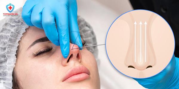 Nâng mũi bằng chỉ sinh học.