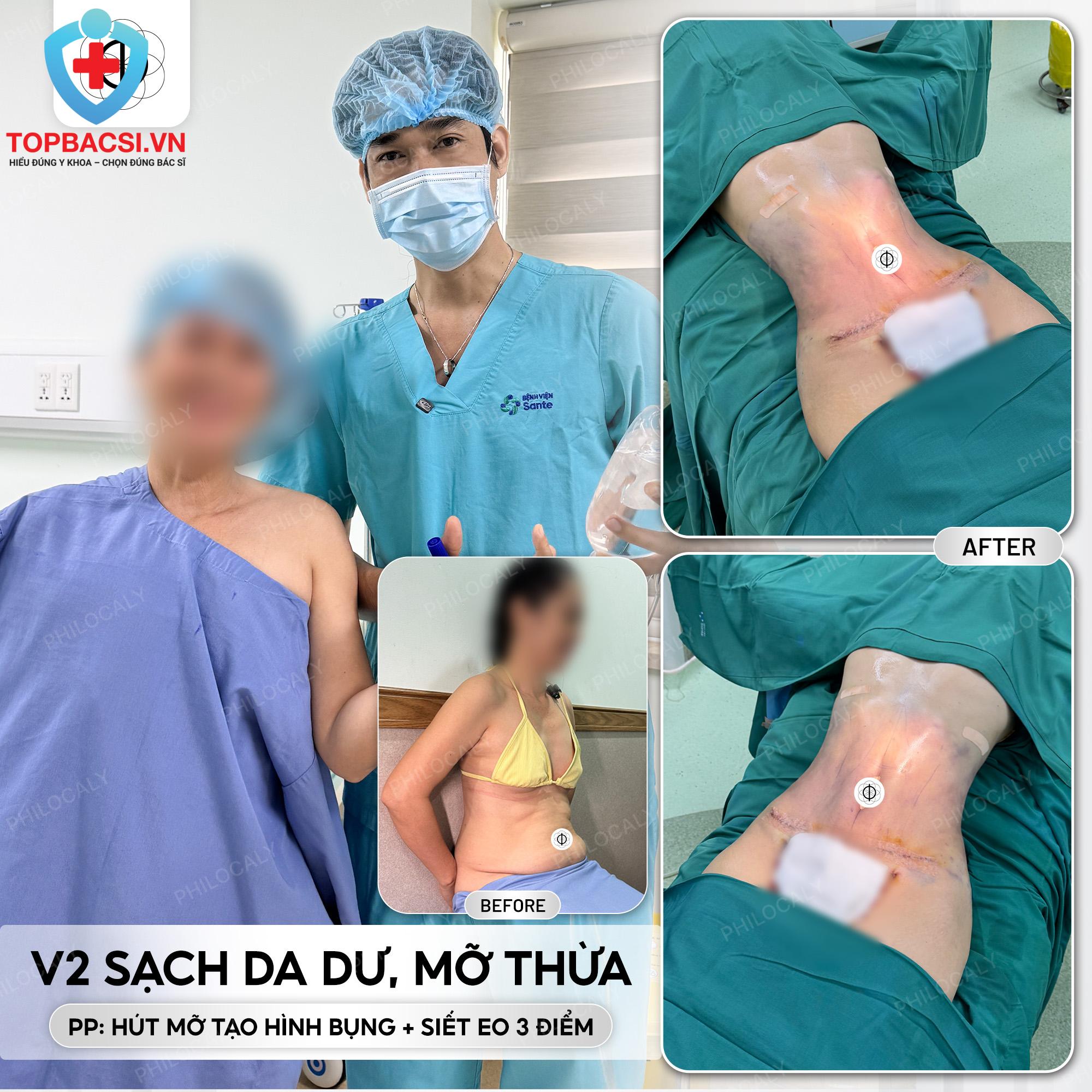 Bác sĩ Huỳnh Tấn Đạt sửa lại thành công ca bụng nhiều da dư mỡ thừa