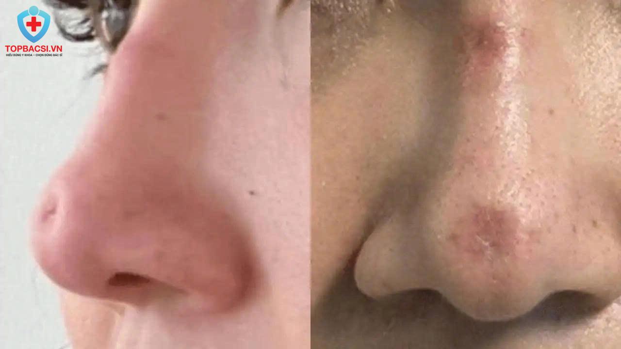 Bóng đỏ đầu mũi và lộ chỉ dưới da sau khi nâng mũi chỉ nhiều năm.