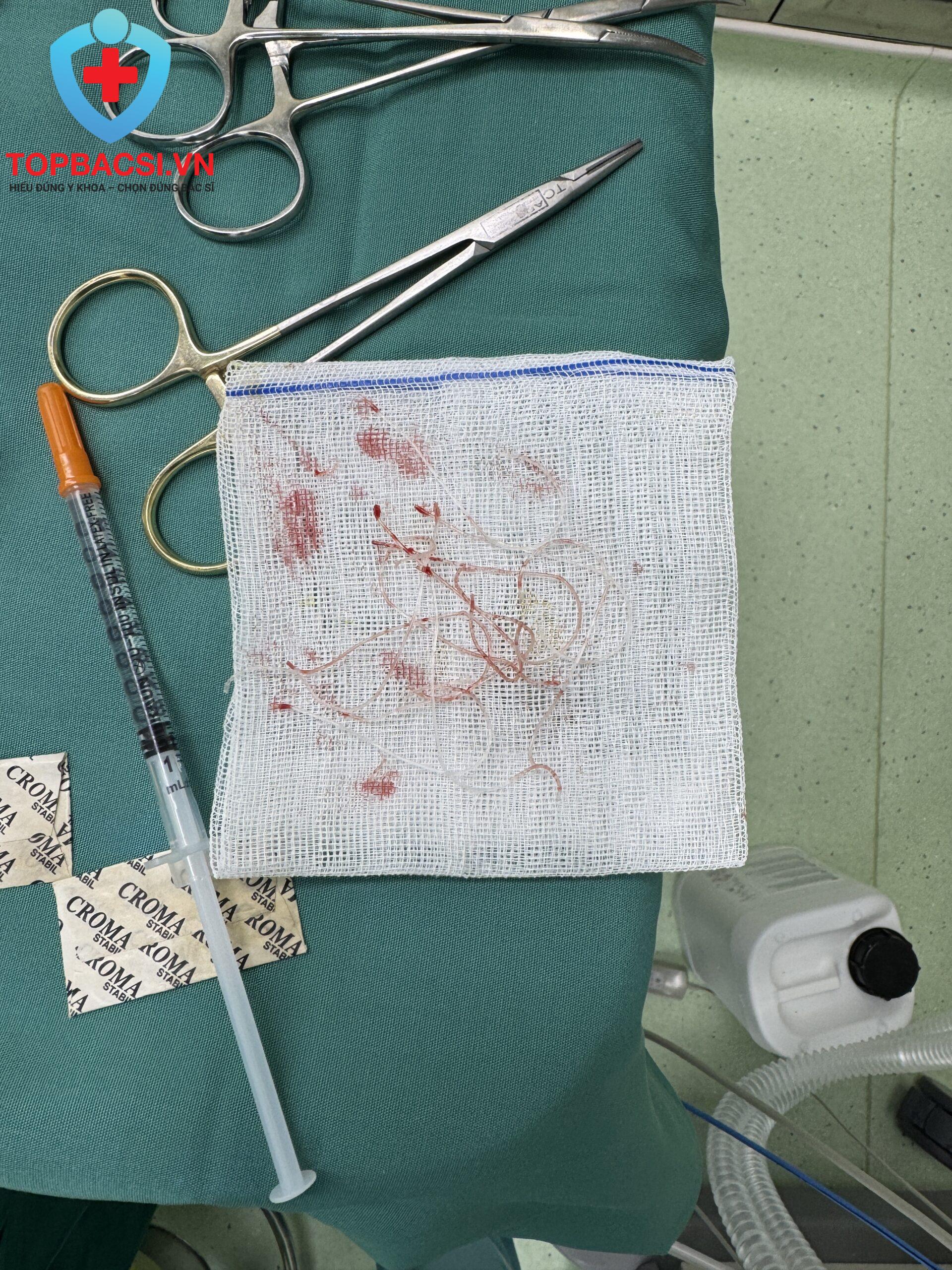 Chỉ được Bác sĩ Phi lấy ra từ mũi bệnh nhân sau 4 năm.
