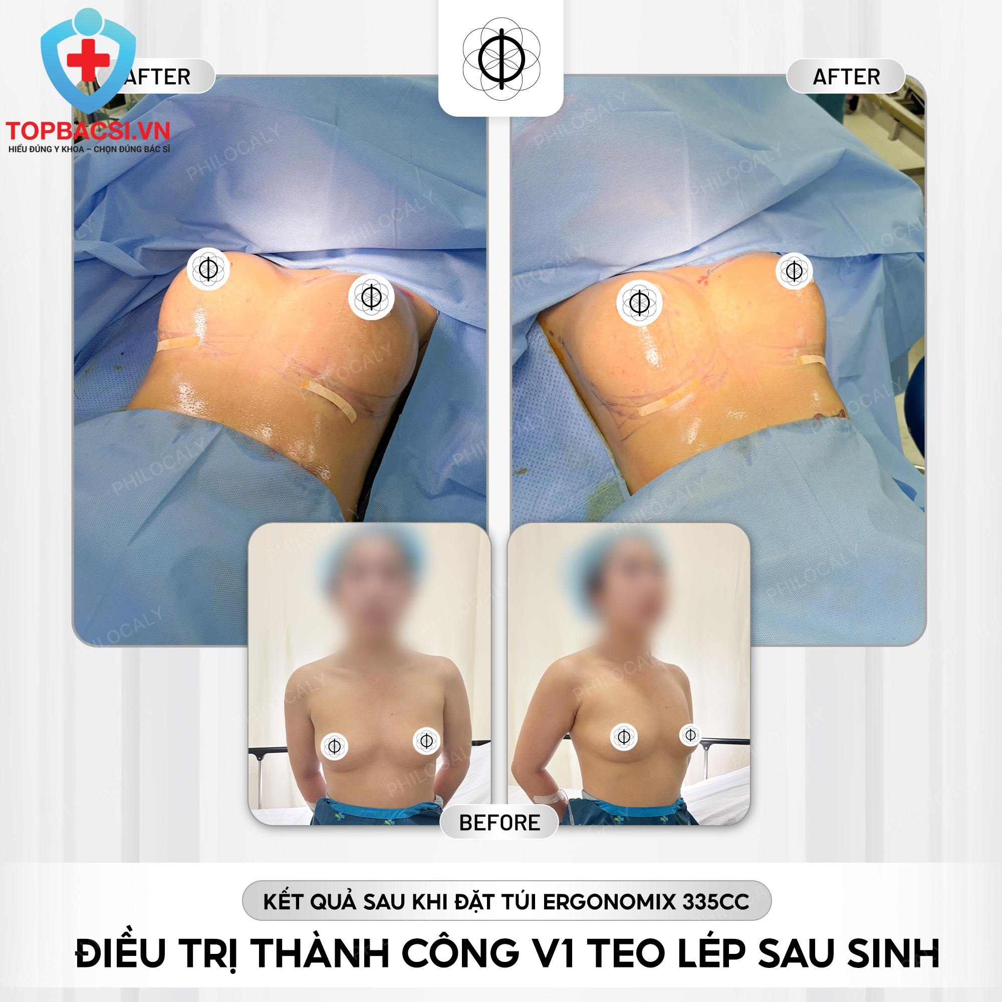 Một ca thẩm mỹ sau sinh được thực hiện bởi Bác sĩ Huỳnh Tấn Đạt