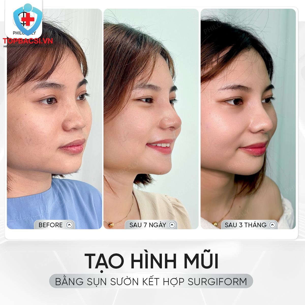 Những mốc hồi phục quan trọng trước khi quay lại thể thao sau nâng mũi