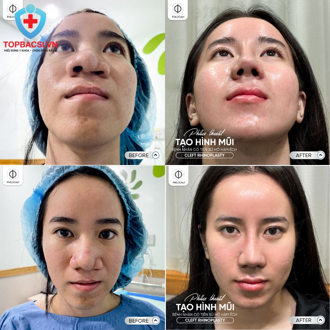 Tạo hình mũi cho Khách hàng hở hàm ếch bẩm sinhđược Bác sĩ Võ Thanh Phi thực hiện thành công
