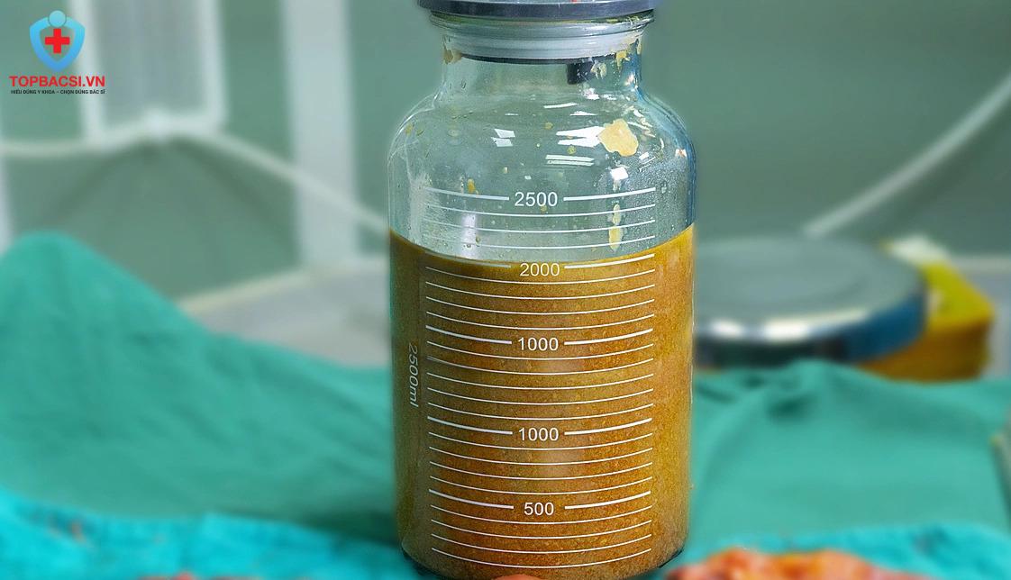 Bình mỡ 2 lít sau khi hút từ khách hàng 