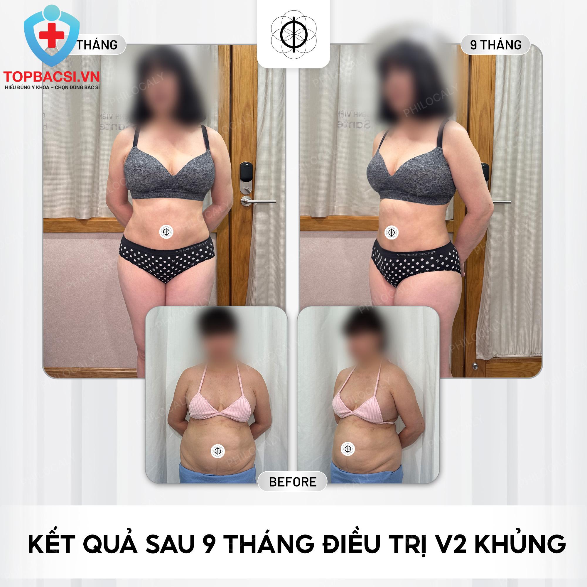 Kết quả sau điều trị hút mỡ cho chị em có Bụng khủng