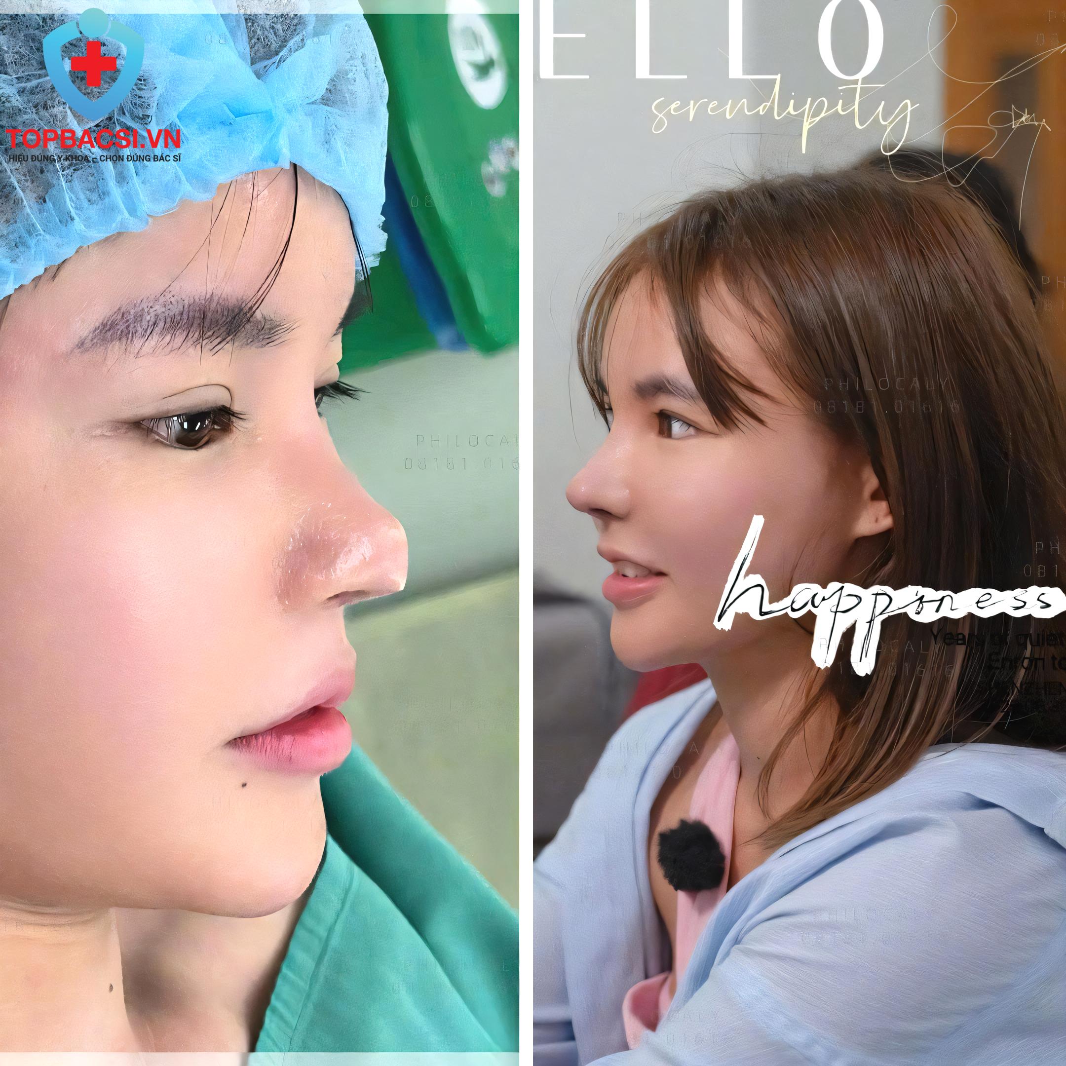 Mũi sau khi được Bác sĩ Võ Thanh Phi sửa lại