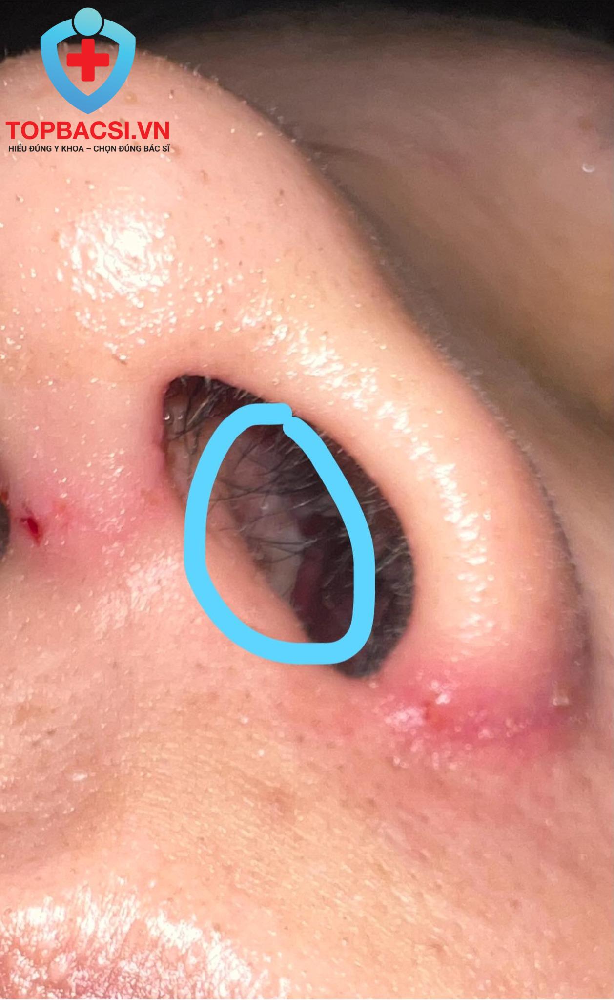 Nguyên nhân lộ sụn vách ngăn do tay nghề Bác sĩ?