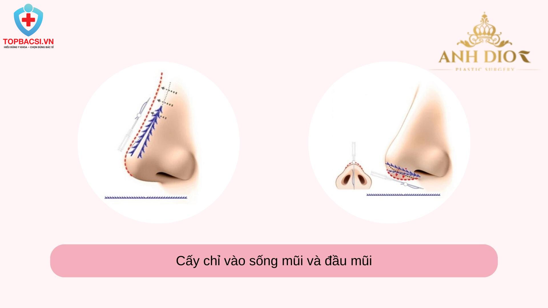 Các sợi chỉ sẽ tạo lực kéo tạm thời giúp sống mũi trông cao hơn hoặc thon hơn trong thời gian nhất định