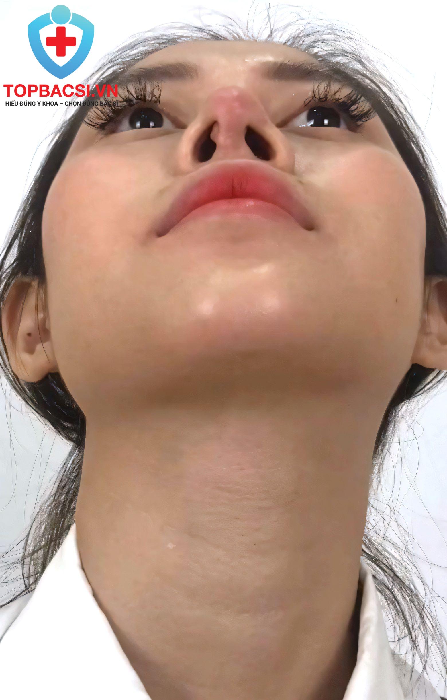 Lộ sụn bên trong mũi | Tay nghề bác sĩ thẩm mỹ "Kém"?