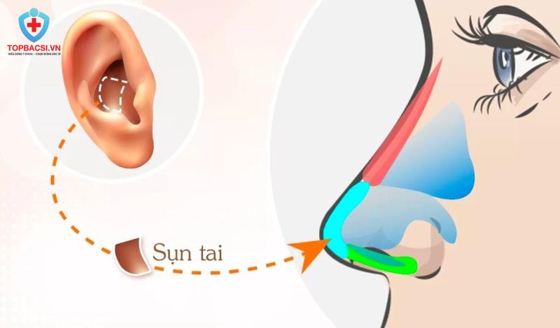 Nâng mũi sụn tai là gì?