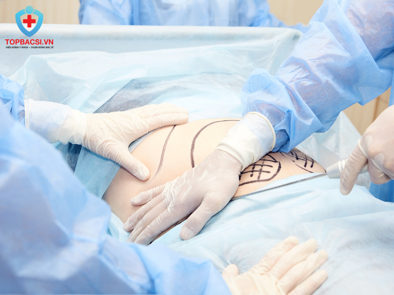 Cần Lưu Ý Gì Trước Khi Thực Hiện Hút Mỡ? 10 Điều Không Nên Bỏ Qua