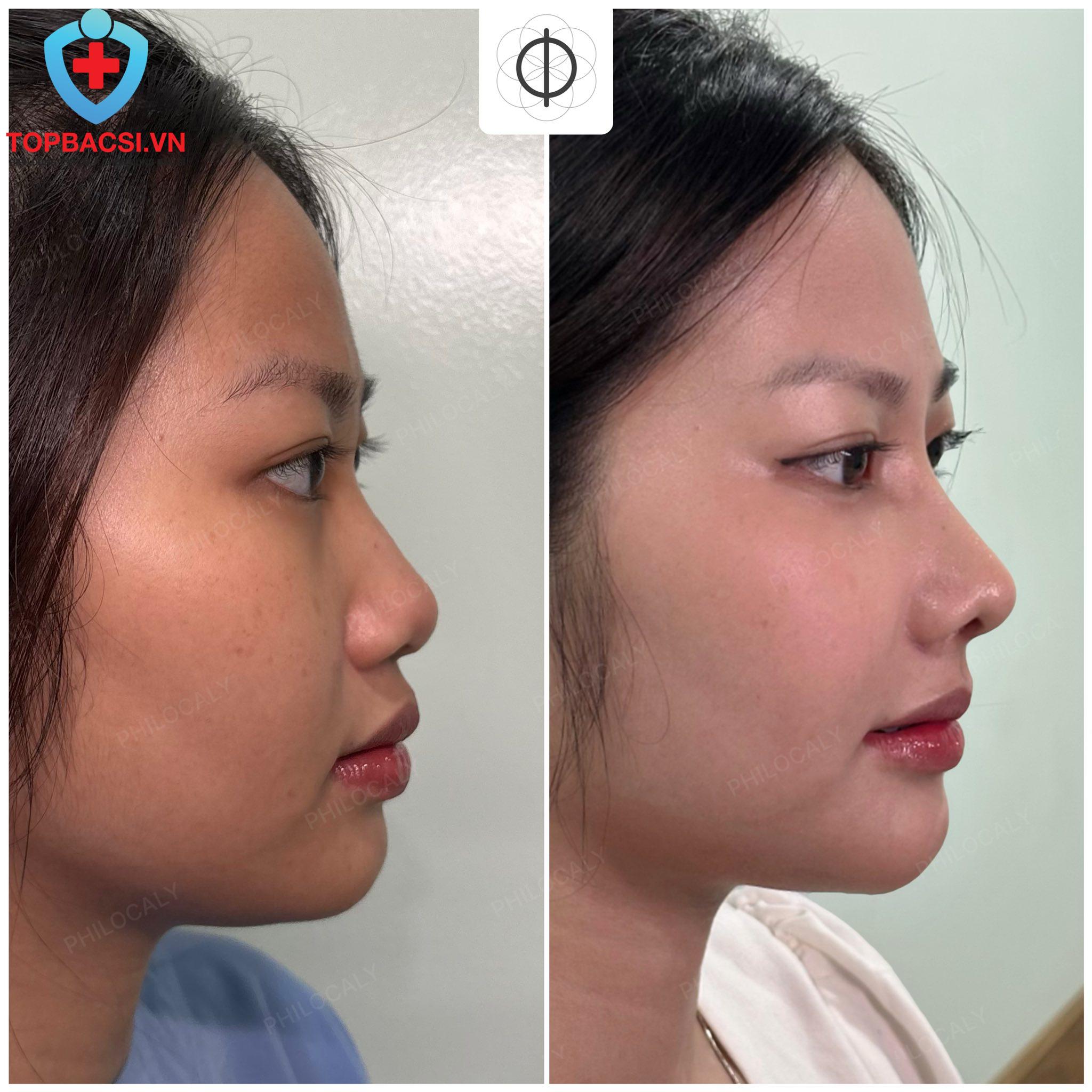 Nâng mũi bao lâu thì được chơi thể thao?