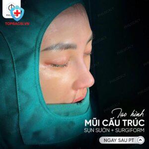 Sau khi nâng mũi cấu trúc sụn sườn + Sugiform
