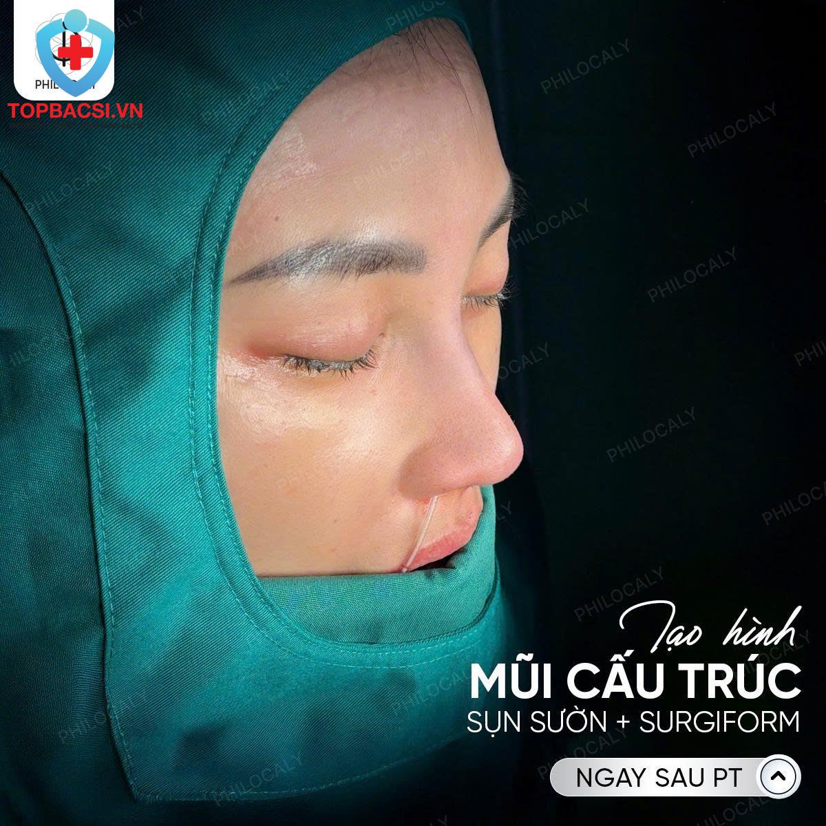 Sau khi nâng mũi cấu trúc sụn sườn + Sugiform
