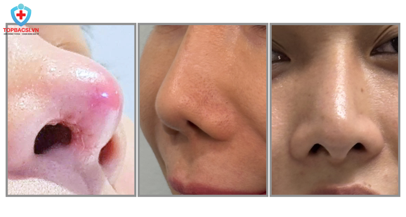 Viêm, co rút và lệch sống là những biến chứng thường gặp khi nâng mũi chỉ