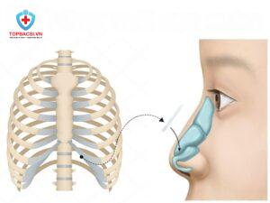 Nâng mũi sụn sườn là gì?