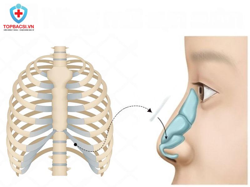 Nâng mũi sụn sườn là gì?